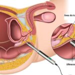 Imagem-resseccao-endoscopica-da-prostata