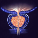 crecimiento-de-la-prostata-urologia-en-monterrey-felix-soriano